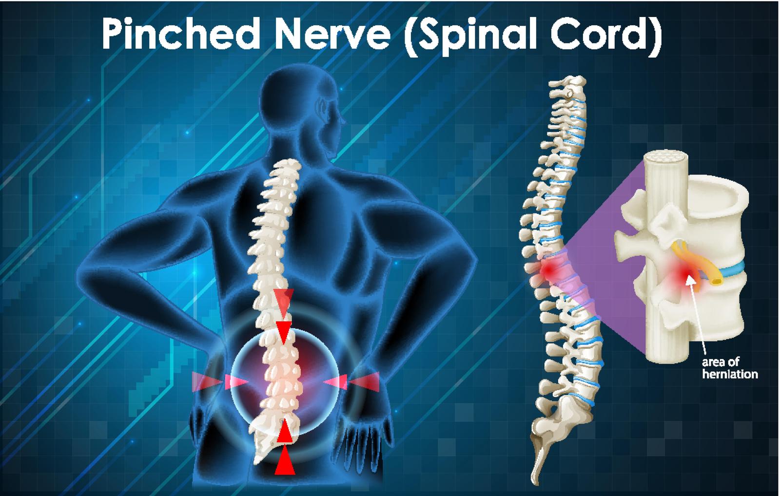 Can A Chiropractor North York Help With Pinched Nerves