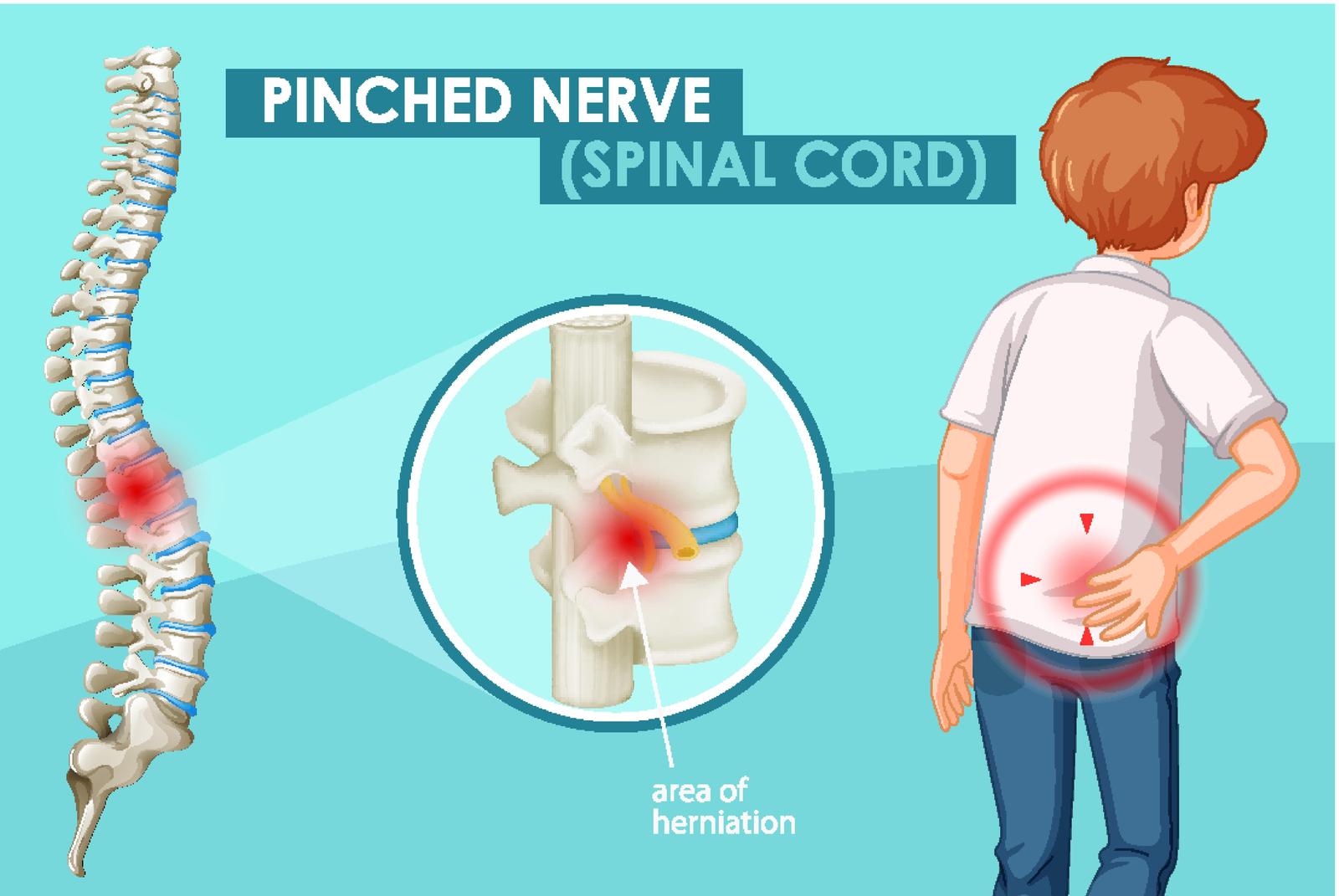 Why Pinched Nerve Responds Well To North York Chiropractic Care